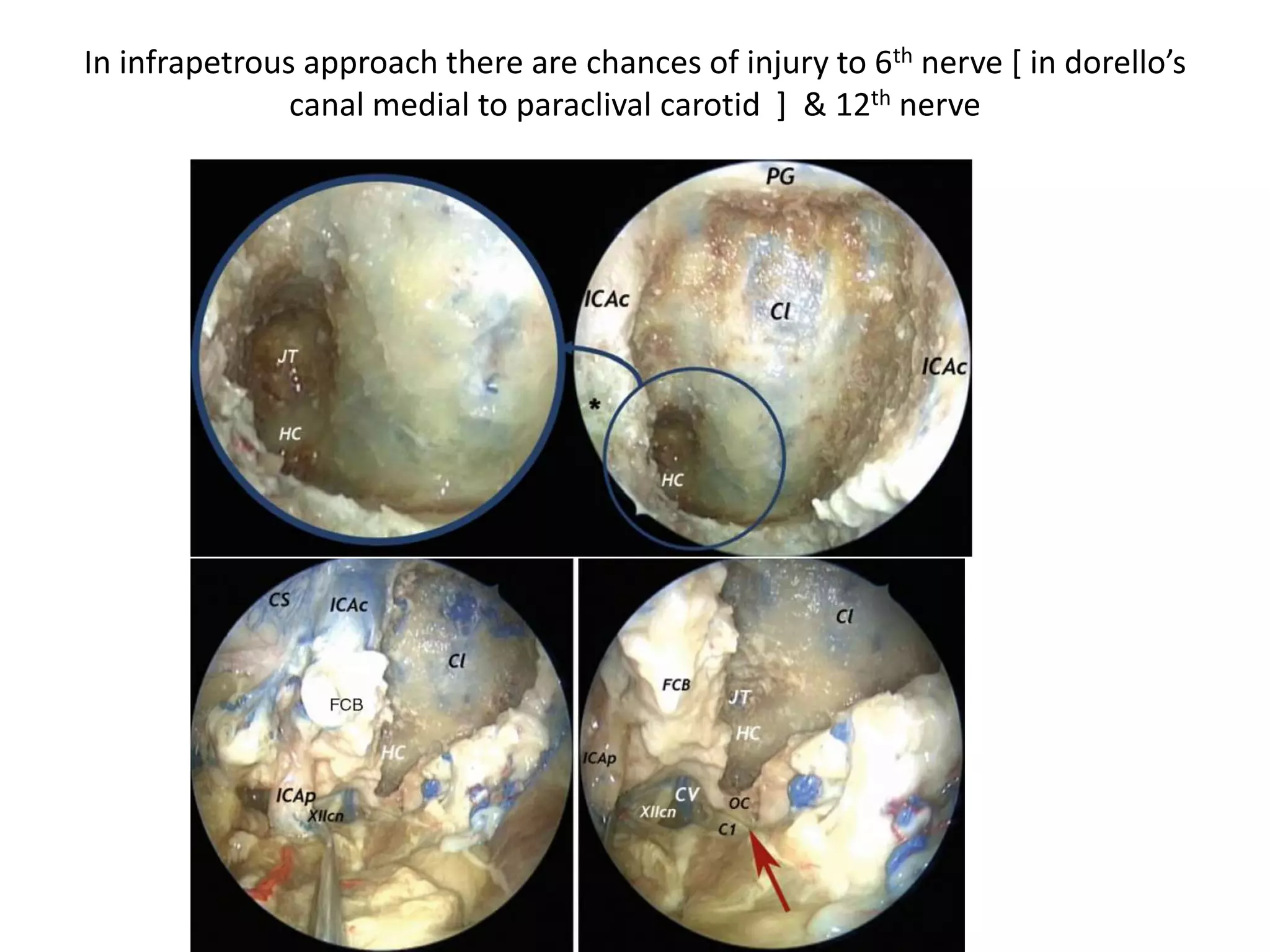 Through endoscopic lateral skull
base - The curved vertebral
artery displaces and stretches
the hypoglossal nerve fibers.
Through anterior skull base
 