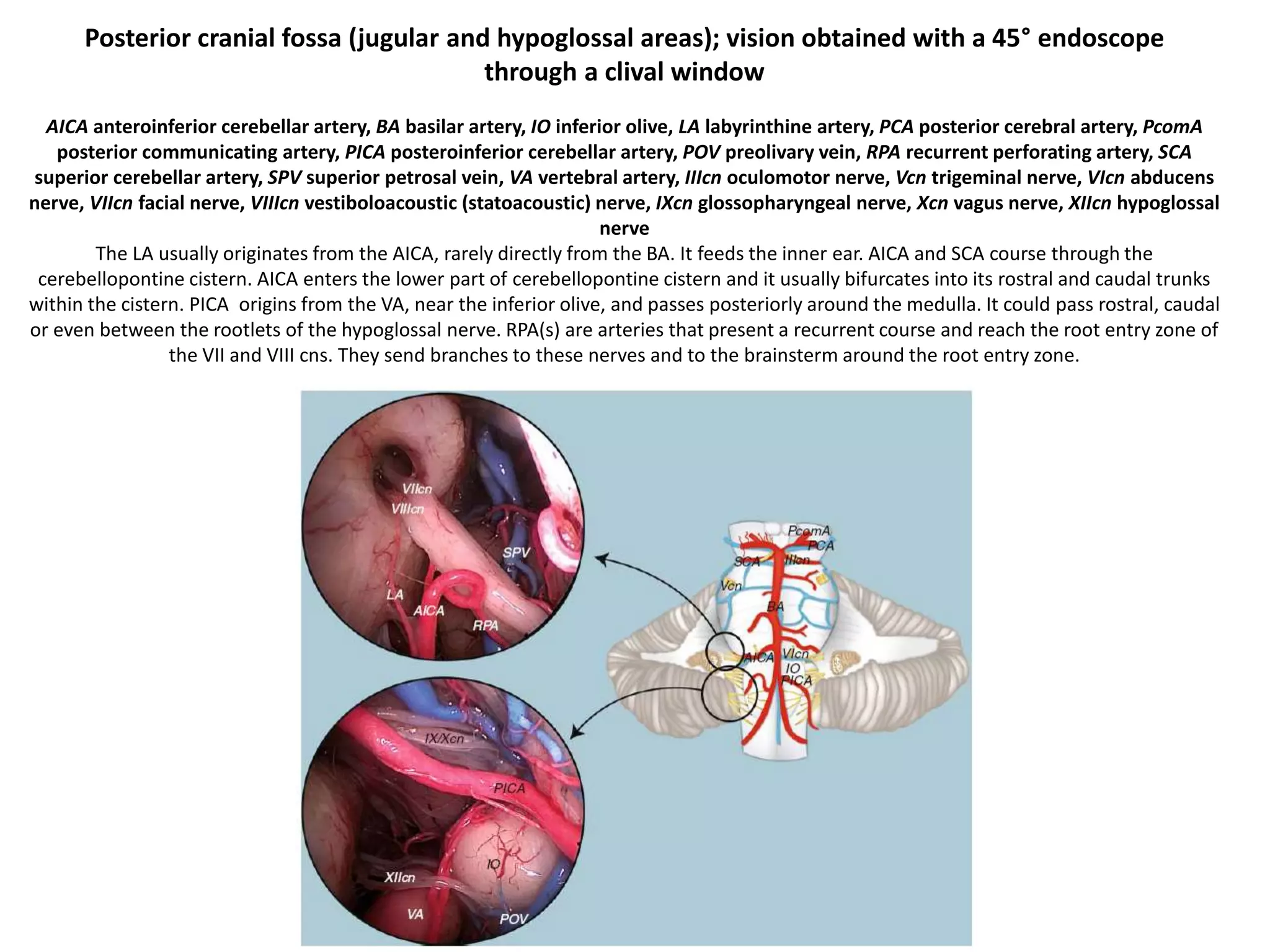 Transoral approach to SUPERO-MEDIAL Parapharyngeal
tumors – incision anterior to anterior pillar of tonsil
 