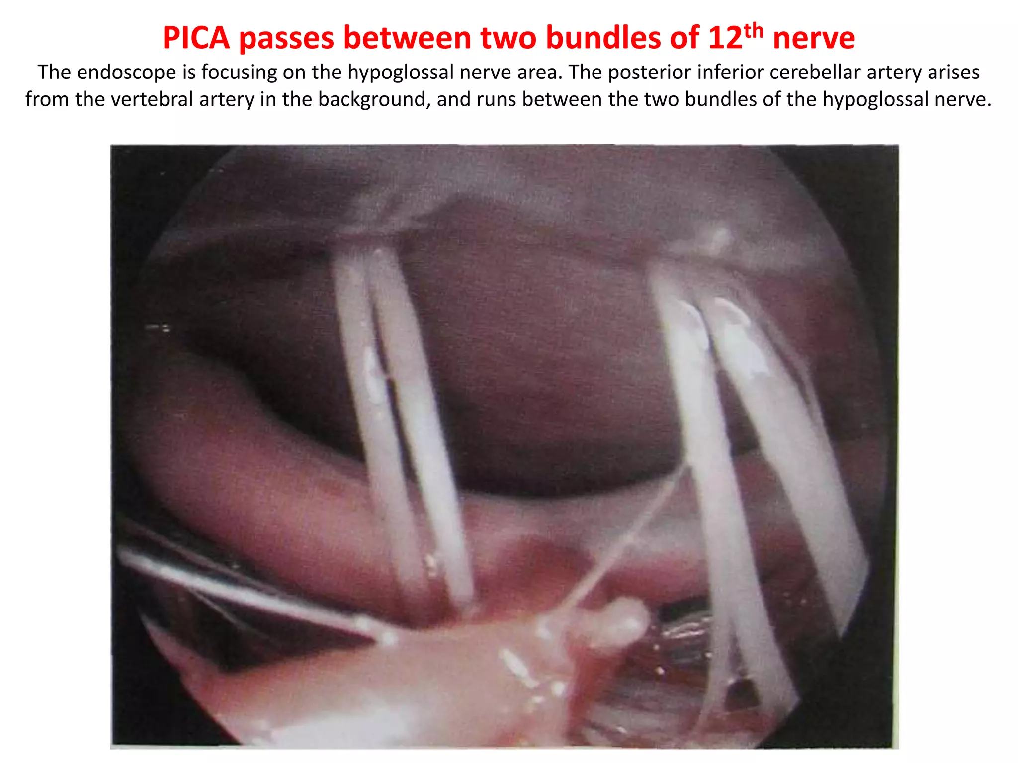 In infrapetrous approach there are chances of injury to 6th nerve [ in dorello’s
canal medial to paraclival carotid ] & 12th nerve
 