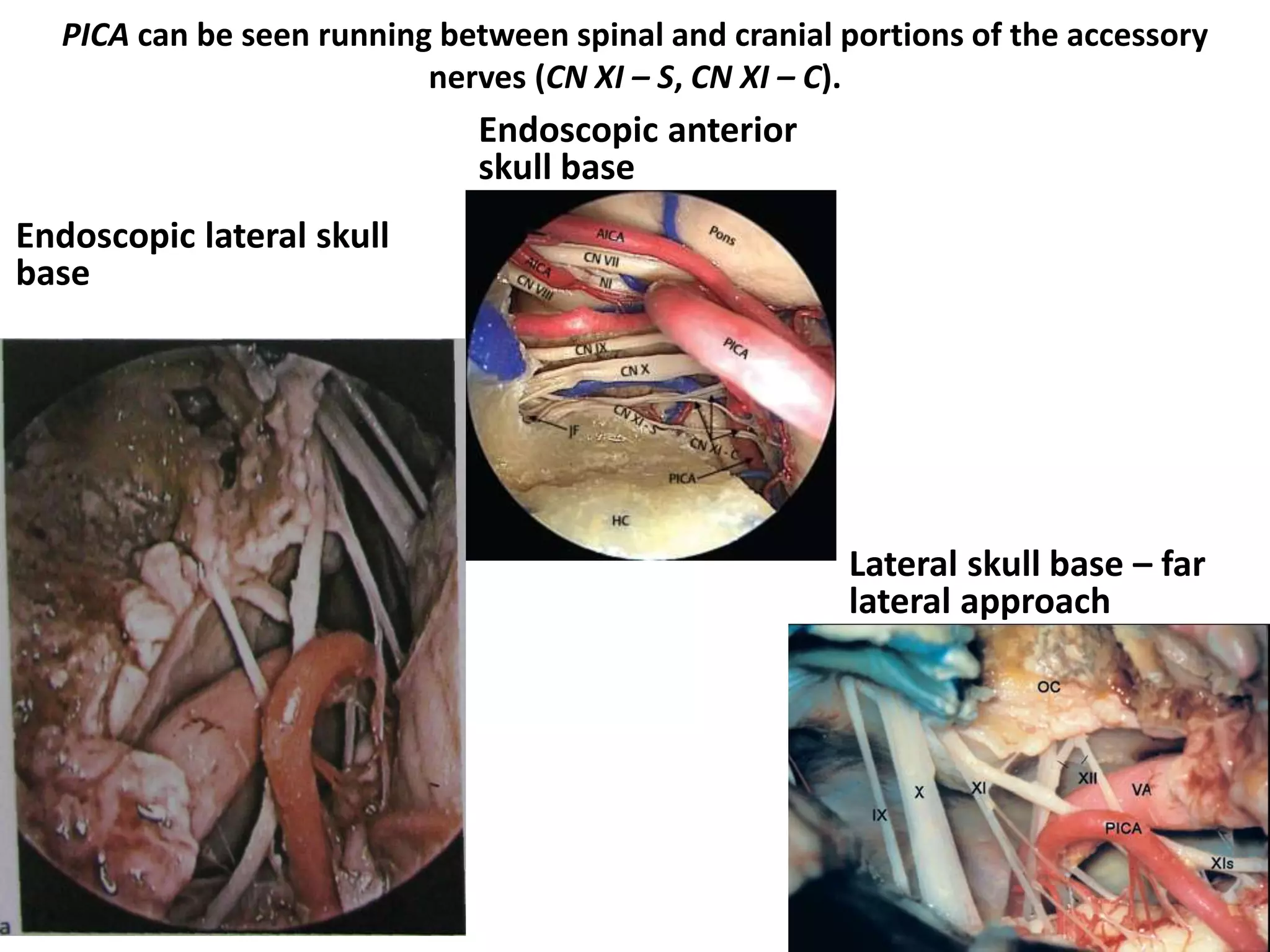 Posterior cranial fossa (jugular and hypoglossal areas); vision obtained with a 45° endoscope
through a clival window
AICA anteroinferior cerebellar artery, BA basilar artery, IO inferior olive, LA labyrinthine artery, PCA posterior cerebral artery, PcomA
posterior communicating artery, PICA posteroinferior cerebellar artery, POV preolivary vein, RPA recurrent perforating artery, SCA
superior cerebellar artery, SPV superior petrosal vein, VA vertebral artery, IIIcn oculomotor nerve, Vcn trigeminal nerve, VIcn abducens
nerve, VIIcn facial nerve, VIIIcn vestiboloacoustic (statoacoustic) nerve, IXcn glossopharyngeal nerve, Xcn vagus nerve, XIIcn hypoglossal
nerve
The LA usually originates from the AICA, rarely directly from the BA. It feeds the inner ear. AICA and SCA course through the
cerebellopontine cistern. AICA enters the lower part of cerebellopontine cistern and it usually bifurcates into its rostral and caudal trunks
within the cistern. PICA origins from the VA, near the inferior olive, and passes posteriorly around the medulla. It could pass rostral, caudal
or even between the rootlets of the hypoglossal nerve. RPA(s) are arteries that present a recurrent course and reach the root entry zone of
the VII and VIII cns. They send branches to these nerves and to the brainsterm around the root entry zone.
 