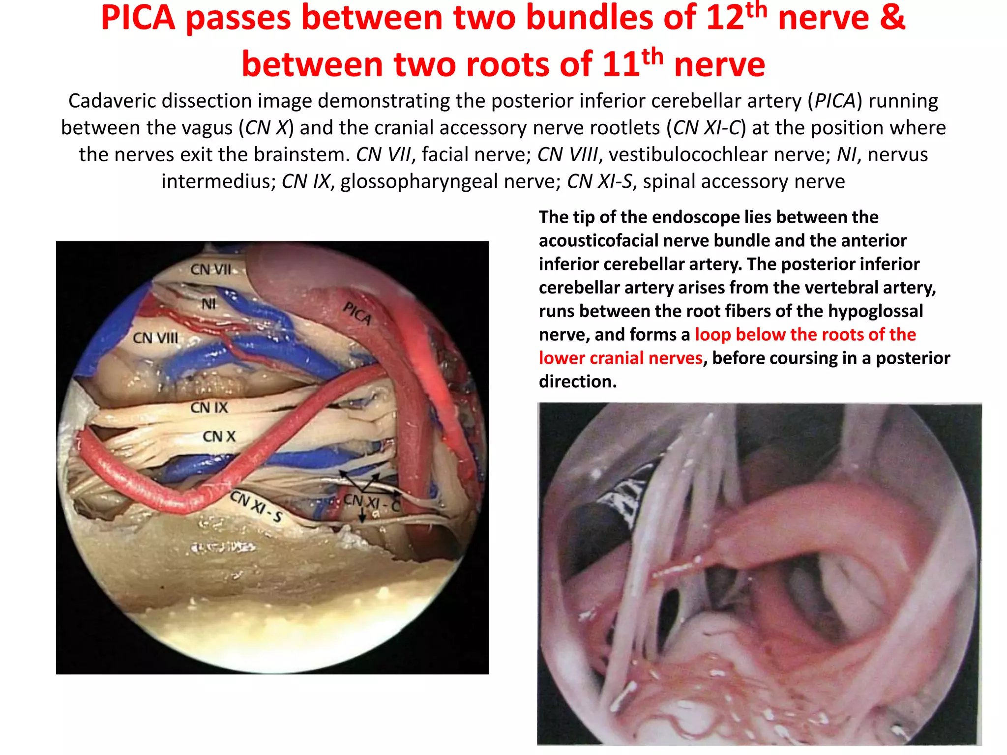 Intracranial hypoglossal region. Anterior endoscopic transnasal-transclival vision is
compared with a posterior retrosigmoid endoscopic one
JF jugular foramen, JT jugular tubercle, IO inferior olive, PICA posteroinferior cerebellar artery, VA vertebral artery, IXcn
glossopharygeal nerve, Xcn vagus nerve, XIcnCR cervical roots of accessory nerve, XIcnSR spinal roots of accessory nerve,
XIIcn hypoglossal nerve
Cranial nerves IX and X present a close relationship with the fi rst portion of the PICA. They are protected by the arachnoid
membrane (Roche et al. 2008 ) . The roots of cranial nerve XIcn from the spine pass through the foramen magnum posterior
to the vertebral artery. Within the hypoglossal canal, XIIcn is surrounded by a venous plexus and dural and arachnoid
sheets. Branches of the ascending pharyngeal artery coursing through the hypoglossal canal are seen in about 50 % of cases
(Lang 1995 ) . Also branches from the posterior meningeal artery have been described (Janfaza and Nadol 2001 ). The
transcisternal vein to the area of the JF can be seen. Also, veins to the hypoglossal canal can be present. The hypoglossal
nerve do not exit with VA. It can have maximum 3 outlets. On the contrary, C1 roots exit with the VA.
 