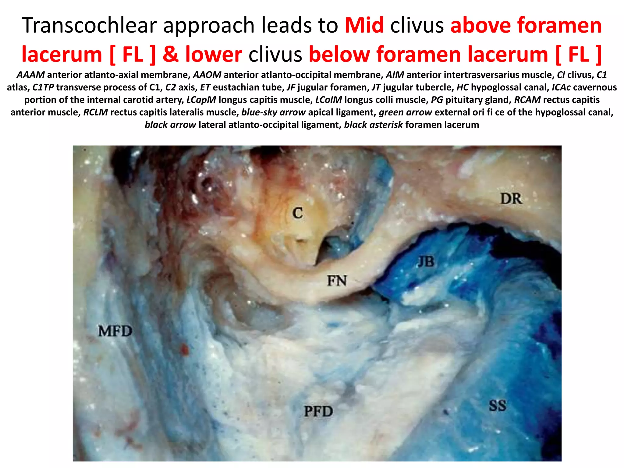Nerves and vessels of the posterior cranial fossa. (a) Basilar tip region, endoscopic view (b) Right cerebellopontine angle, endoscopic view from
anterior. (c) Right laterobulbar region, endoscopic intracranial view. (d) Three-dimensional reconstruction of the posterior cranial fossa. AICA,
anteroinferior cerebellar artery; BA, basilar artery; DV, Dandy’s vein; Fl, flocculus; IIIcn (CS), intracavernous portion of the oculomotor nerve; IIIcn,
oculomotor nerve; IO, inferior olive; IXcn, glossopharyngeal nerve; IX–X, glossopharyngeal and vagus nerves; LA, labyrinthic artery; LPMVN,
lateropontomesencephalic vein network; P1, posterior cerebral artery (first segment); P2, posterior cerebral artery (second segment); PcomA,
posterior communicating artery; PICA, posteroinferior cerebellar artery; POV, preolivary vein; PV, peduncular vein; RPA, recurrent perforating
artery; SCA, superior cerebellar artery; SPV, superior petrosal vein; TGAs, thalamogeniculate arteries; TPAs, thalamoperforating arteries; VA,
vertebral artery; Vcn, trigeminal nerve; VIcn, abducens nerve;
VII–VIIIcn, facial nerve and vestibuloacoustic nerve; VIIcn, facial nerve; VIIIcn, vestibuloacoustic nerve; X/XIcn, vagus and accessory nerves; XIcn,
accessory nerve; XIIcn, hypoglossal nerve.
 