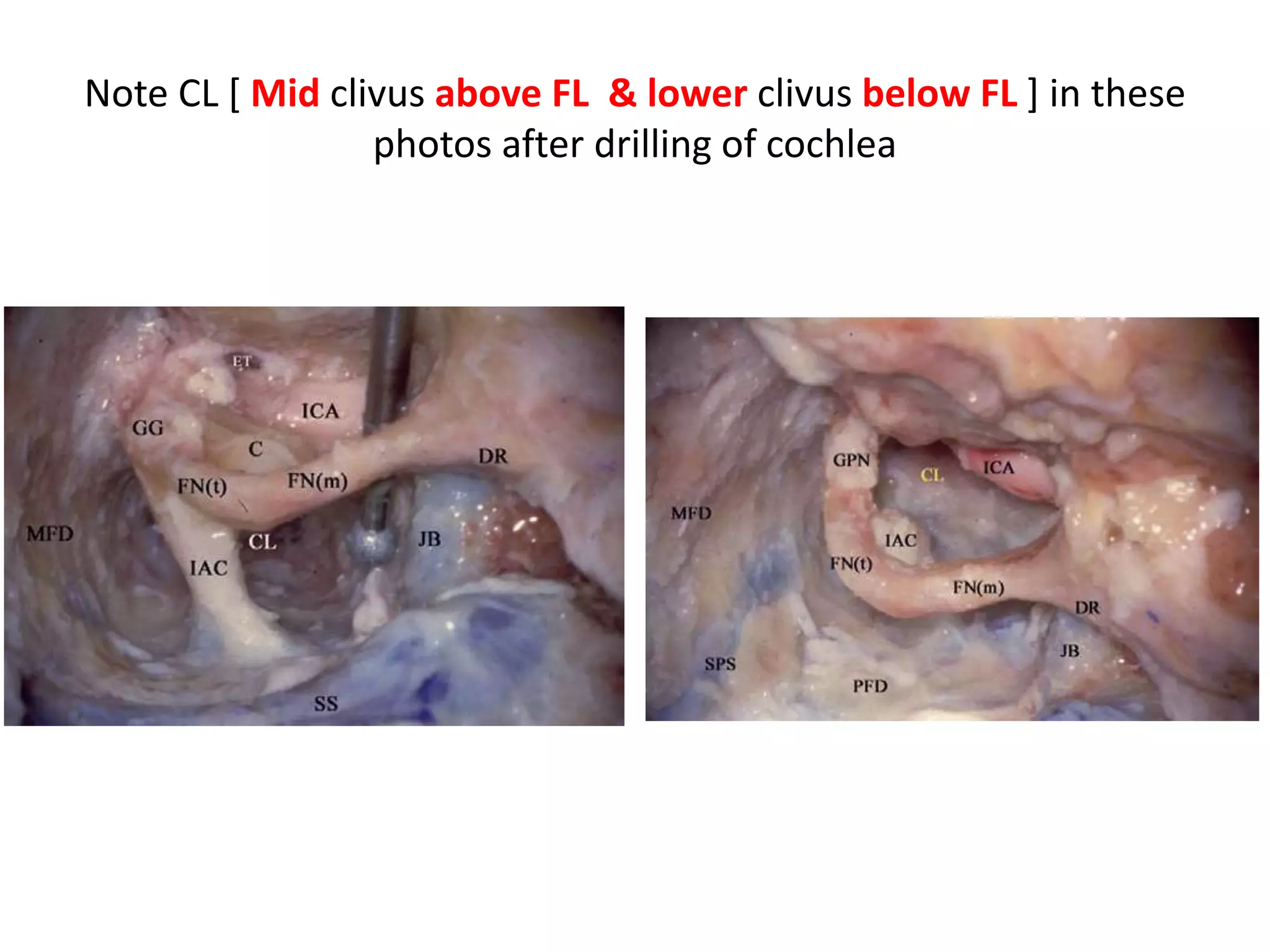 TPV & LAPMVs , PMedSV unite to form SPV
AICA anteroinferior cerebellar artery, BA basilar artery, LPMVN
lateropontomesencephalic venous network, PBs pontine branches, PcomA posterior
communicating artery, PICA posteroinferior cerebellar artery, PMedSV
pontomedullary sulcus vein, SCA superior cerebellar artery, SPV superior petrosal
vein, TPAs talamoperforating arteries, TPV transverse pontine vein, IIIcn oculomotor
nerve, Vcn trigeminal nerve, VIcn abducens nerve, VIIcn facial nerve, VIIIcn vestibulo-
cochlear (statoacoustic) nerve
 