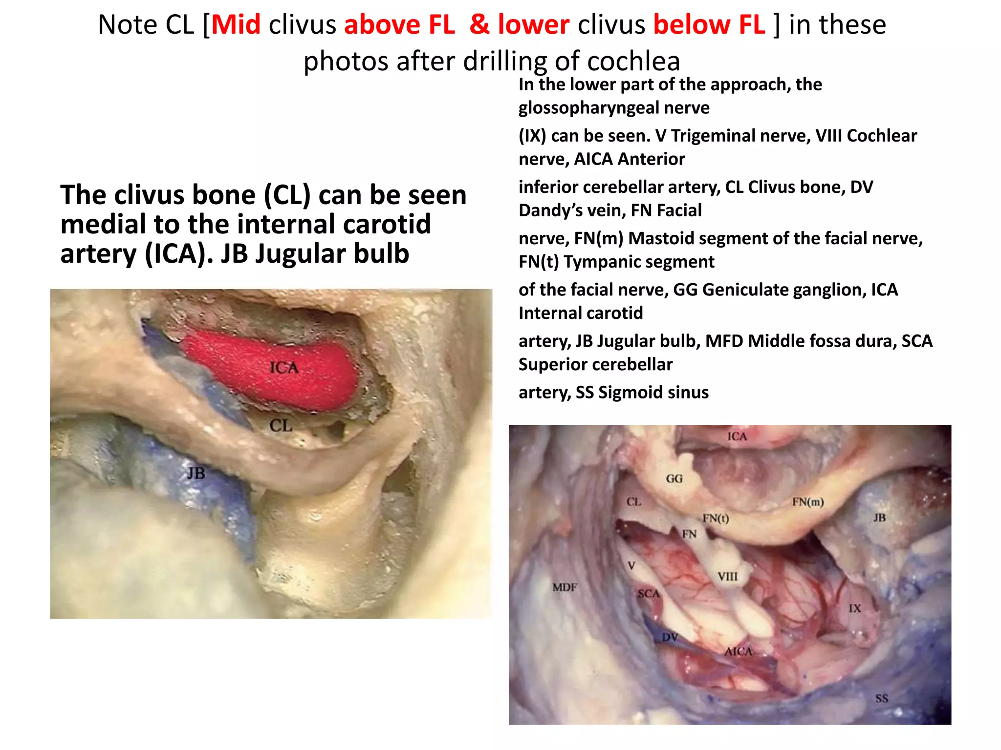 PICA passes between two bundles of 12th nerve
The endoscope is focusing on the hypoglossal nerve area. The posterior inferior cerebellar artery arises
from the vertebral artery in the background, and runs between the two bundles of the hypoglossal nerve.
 