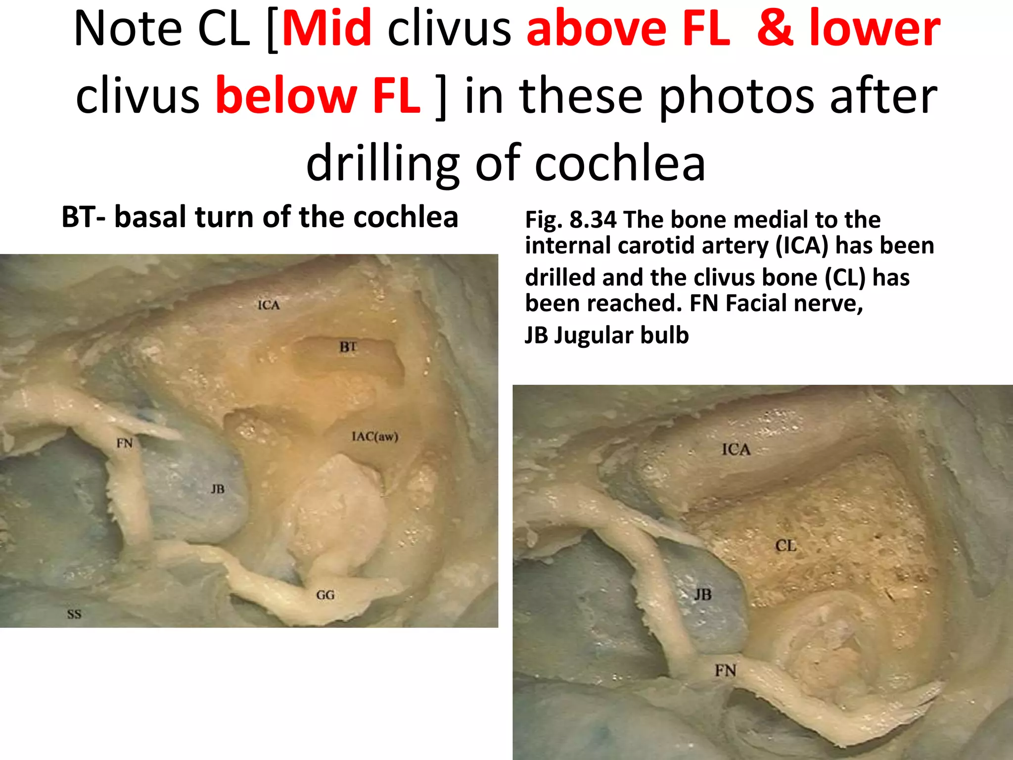 PICA can be seen running between the vagus (CN X)
 