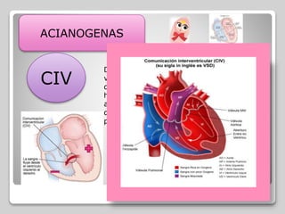 ACIANOGENAS
CIV
COMUNICACIÓN INTERVENTRICULAR
Defecto embriológico consiste en uno o
varios orificios en el que el tabique que
divide al V izq, que tiene mayor presión ,
hacia el Vd de menos presión
aumentando volumen de ventrículo
derecho :HIPERFLUJO pulmonar y
provoca congestión pulmonar
 