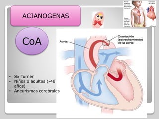 CoA
ACIANOGENAS
COARTACION AORTICA
Estrechamiento de la aorta torácica en la
región próxima a donde se encuentra el
ductus arteriosus : INSUFICIENCIA
CARDIACA
• Se asocia a anomalías del corazón
como VALVULA AORTICA BICUSPIDE Y
CIV• Sx Turner
• Niños o adultos (-40
años)
• Aneurismas cerebrales
 