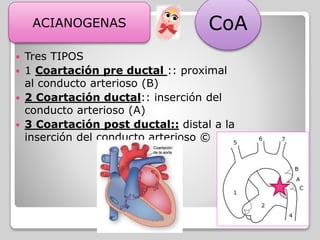  Tres TIPOS
 1 Coartación pre ductal :: proximal
al conducto arterioso (B)
 2 Coartación ductal:: inserción del
conducto arterioso (A)
 3 Coartación post ductal:: distal a la
inserción del conducto arterioso ©
CoAACIANOGENAS
 