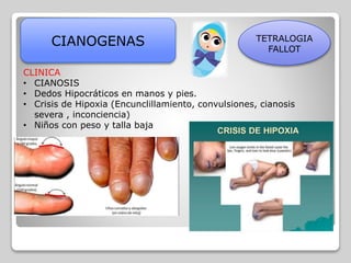 CIANOGENAS TETRALOGIA
FALLOT
CLINICA
• CIANOSIS
• Dedos Hipocráticos en manos y pies.
• Crisis de Hipoxia (Encunclillamiento, convulsiones, cianosis
severa , inconciencia)
• Niños con peso y talla baja
 