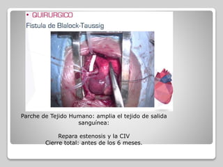 Parche de Tejido Humano: amplia el tejido de salida
sanguínea:
Repara estenosis y la CIV
Cierre total: antes de los 6 meses.
 
