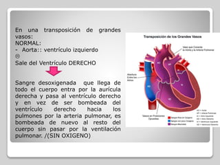 En una transposición de grandes
vasos:
NORMAL:
- Aorta:: ventrículo izquierdo

Sale del Ventrículo DERECHO
Sangre desoxigenada que llega de
todo el cuerpo entra por la aurícula
derecha y pasa al ventrículo derecho
y en vez de ser bombeada del
ventrículo derecho hacia los
pulmones por la arteria pulmonar, es
bombeada de nuevo al resto del
cuerpo sin pasar por la ventilación
pulmonar. /(SIN OXIGENO)
 