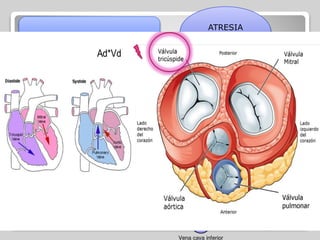CIANOGENAS
ATRESIA
TRICUSPIDE
Caracterizada por la
AUSENCIA TOTAL DE
VÁLVULA TRICÚSPIDE, lo
que impide el paso de la
sangre de la aurícula
derecha al ventrículo
derecho
 