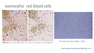 Isomorphic Rbc Urine URINE Sediment Analysis in Clinical Pathology | PPTX