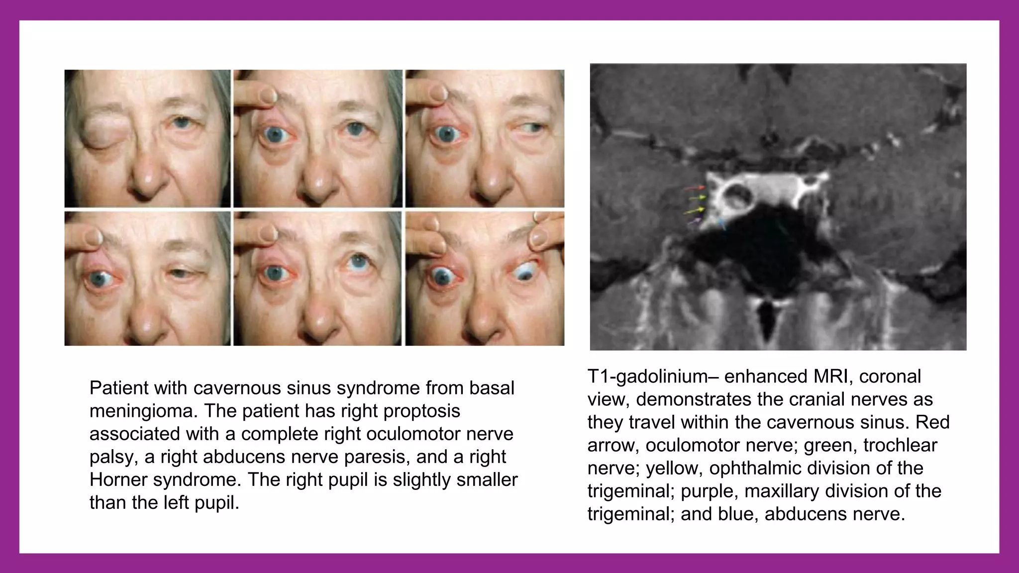 Ocular nerve palsy - 3rd, 4th and 6th cranial nerve palsy | PPTX