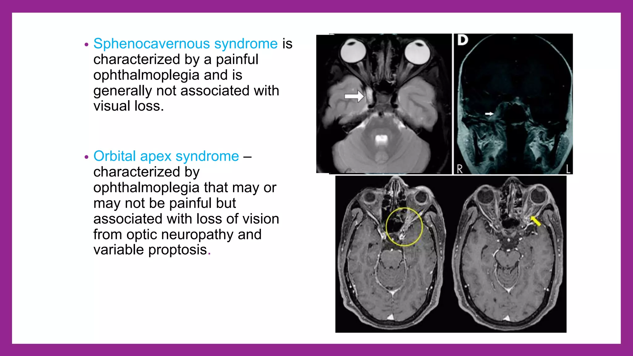 Ocular nerve palsy - 3rd, 4th and 6th cranial nerve palsy | PPTX