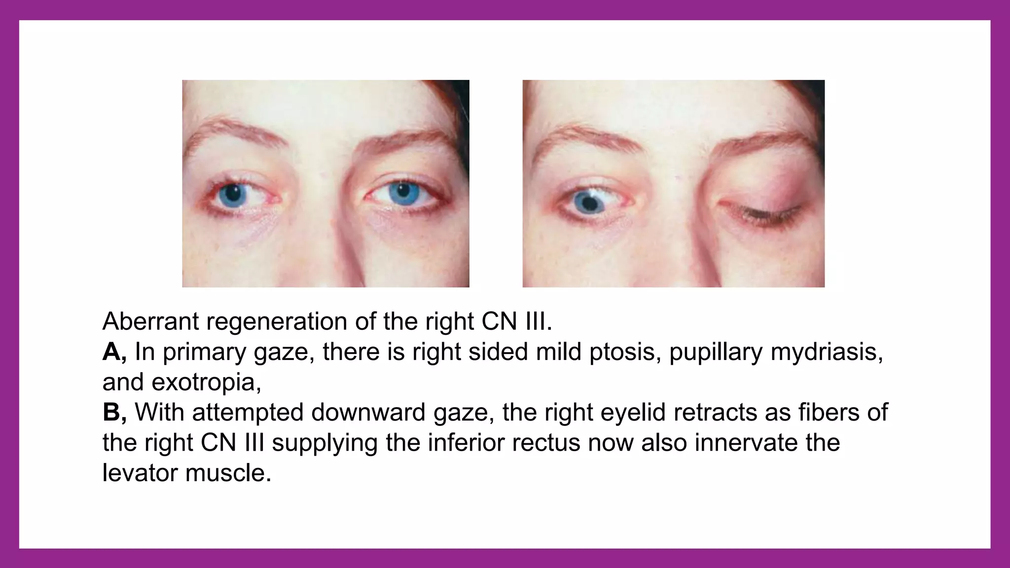 Ocular nerve palsy - 3rd, 4th and 6th cranial nerve palsy | PPTX