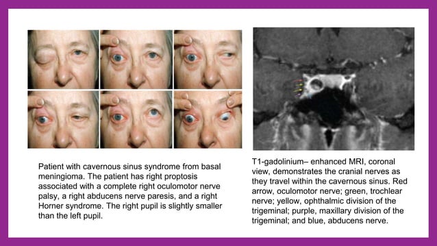 Ocular nerve palsy - 3rd, 4th and 6th cranial nerve palsy | PPTX | Eye ...