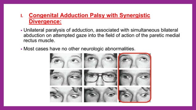 Ocular nerve palsy - 3rd, 4th and 6th cranial nerve palsy | PPTX | Eye ...