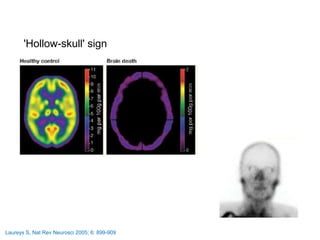 Laureys S, Nat Rev Neurosci 2005; 6: 899-909
'Hollow-skull' sign
 