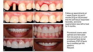 Follow-up appointments at
1 week [Figure 3c] and 2
months [Figure 3d] showed
that the soft tissue responded
favorably, and bone
augmentation was left to heal
for 4 months.
Provisional crowns were
splinted and fabricated
from bis-acryl as a 4-unit
provisional fixed dental
prosthesis (FDP) [Figure
4a-c] modified per the
patient’s
Request.
 