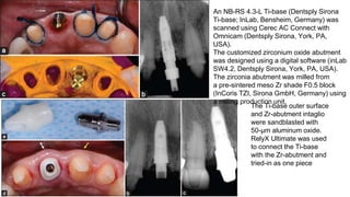 An NB-RS 4.3-L Ti-base (Dentsply Sirona
Ti-base; InLab, Bensheim, Germany) was
scanned using Cerec AC Connect with
Omnicam (Dentsply Sirona, York, PA,
USA).
The customized zirconium oxide abutment
was designed using a digital software (inLab
SW4.2, Dentsply Sirona, York, PA, USA).
The zirconia abutment was milled from
a pre-sintered meso Zr shade F0.5 block
(InCoris TZI, Sirona GmbH, Germany) using
a milling production unit.
The Ti-base outer surface
and Zr-abutment intaglio
were sandblasted with
50-μm aluminum oxide.
RelyX Ultimate was used
to connect the Ti-base
with the Zr-abutment and
tried-in as one piece
 