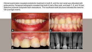 Clinical examination revealed endodontic treatment in tooth 8, and the root canal was obturated with
gutta-percha. Periapi...