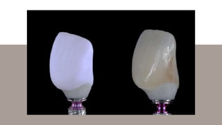 Reference
s
1. Mostafavi AS, Mojtahedi H, Javanmard A. Hybrid
implant abutments: a literature review. European Journal
of ...