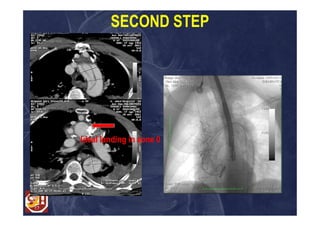 SECOND STEP




Ideal landing in zone 0
 