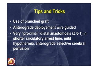 Tips and Tricks
• Use of branched graft
• Anterograde deployement wire guided
• Very “proximal” distal anastomosis (Z 0-1) in
  shorter circulatory arrest time, mild
  hypothermia, anterograde selective cerebral
  perfusion
 