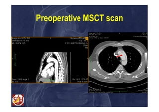Preoperative MSCT scan
 