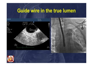 Guide wire in the true lumen
 