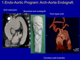 1.Endo-Aortic Program: Arch-Aorta Endograft.
Arch aneurysm
Branched arch endograft
Post repair arch
Courtesy cook Australia
 