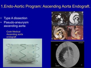 Cook Medical
Ascending aorta
endograft
1.Endo-Aortic Program: Ascending Aorta Endograft.
• Type A dissection
• Pseudo-aneurysm
ascending aorta
 
