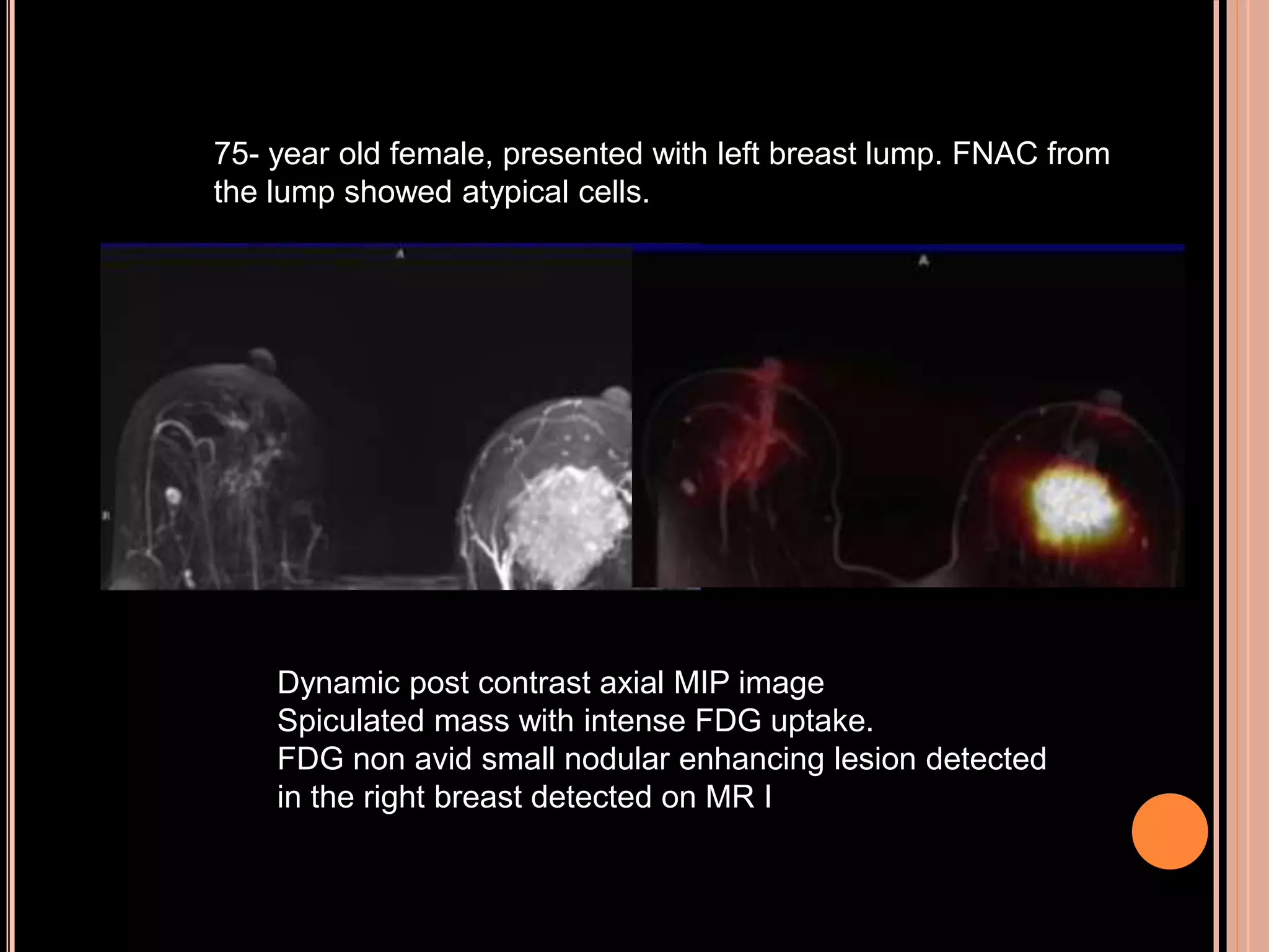 75- year old female, presented with left breast lump. FNAC from
the lump showed atypical cells.
Dynamic post contrast axial MIP image
Spiculated mass with intense FDG uptake.
FDG non avid small nodular enhancing lesion detected
in the right breast detected on MR I
 