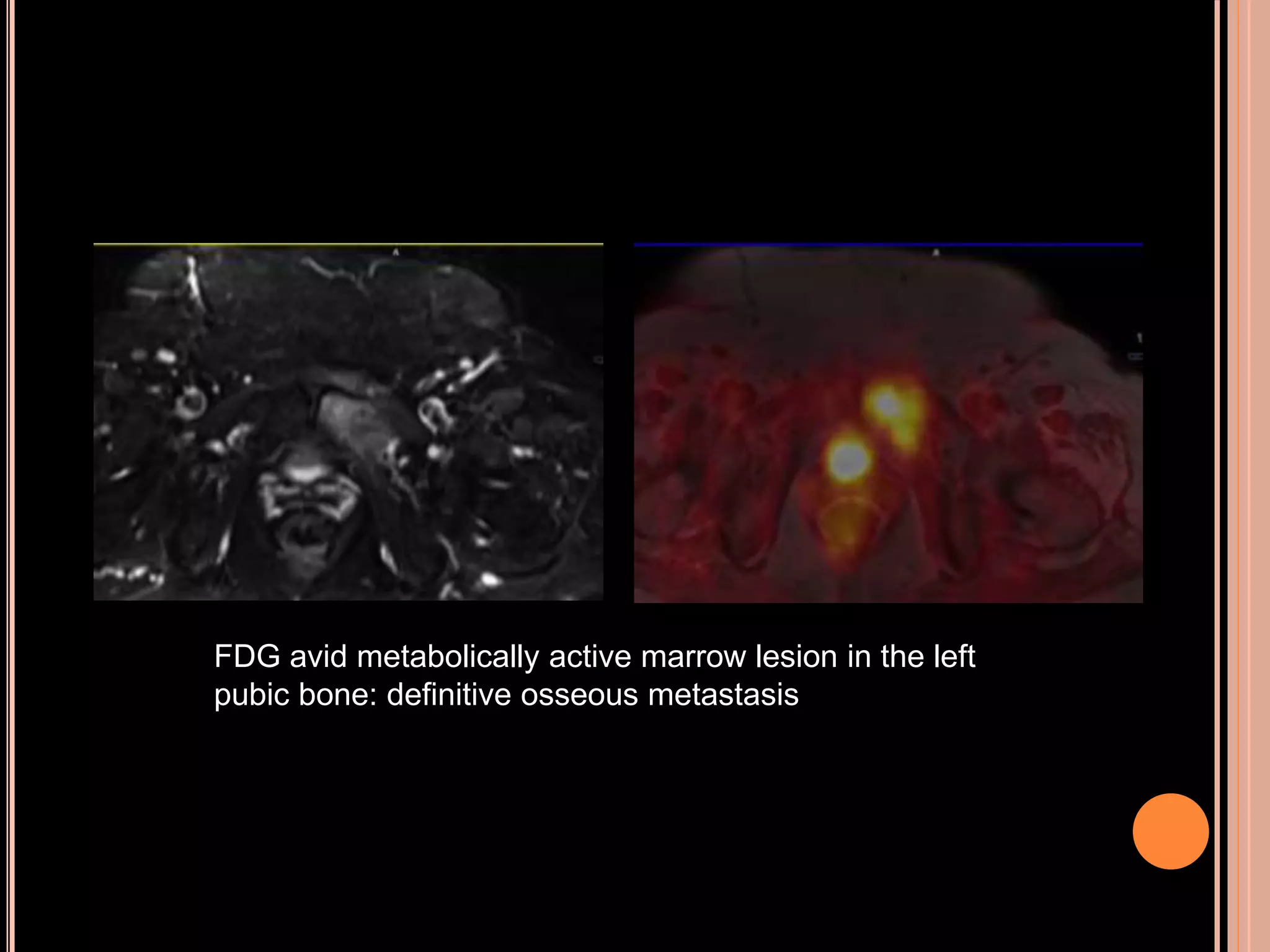 FDG avid metabolically active marrow lesion in the left
pubic bone: definitive osseous metastasis
 