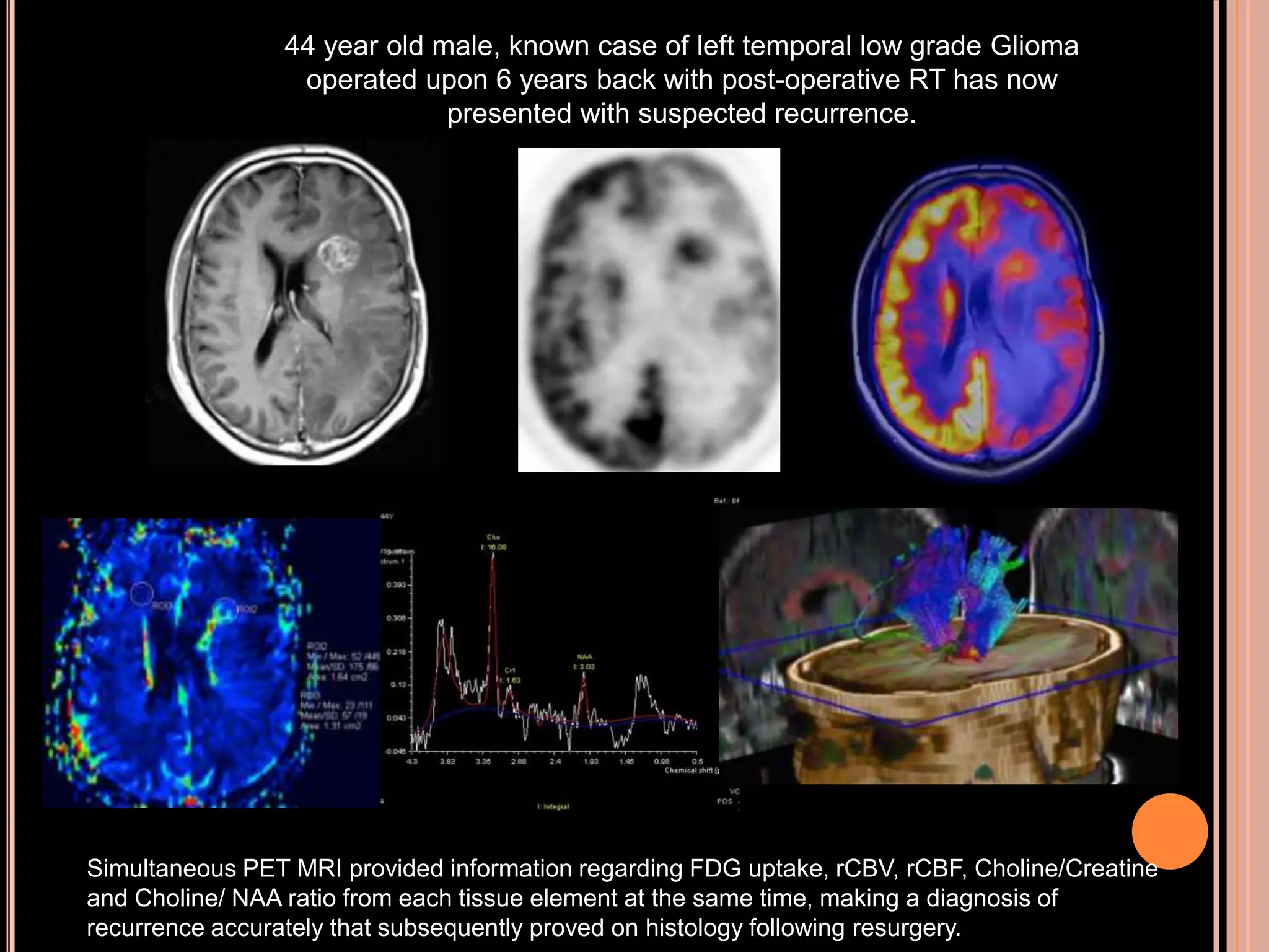 44 year old male, known case of left temporal low grade Glioma
operated upon 6 years back with post-operative RT has now
presented with suspected recurrence.
Simultaneous PET MRI provided information regarding FDG uptake, rCBV, rCBF, Choline/Creatine
and Choline/ NAA ratio from each tissue element at the same time, making a diagnosis of
recurrence accurately that subsequently proved on histology following resurgery.
 
