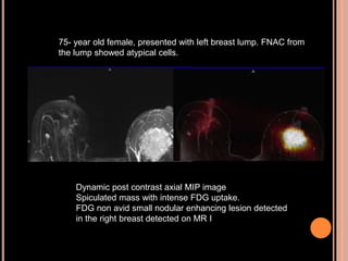 75- year old female, presented with left breast lump. FNAC from
the lump showed atypical cells.
Dynamic post contrast axial MIP image
Spiculated mass with intense FDG uptake.
FDG non avid small nodular enhancing lesion detected
in the right breast detected on MR I
 