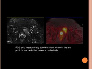 FDG avid metabolically active marrow lesion in the left
pubic bone: definitive osseous metastasis
 