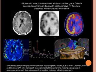 44 year old male, known case of left temporal low grade Glioma
operated upon 6 years back with post-operative RT has now
presented with suspected recurrence.
Simultaneous PET MRI provided information regarding FDG uptake, rCBV, rCBF, Choline/Creatine
and Choline/ NAA ratio from each tissue element at the same time, making a diagnosis of
recurrence accurately that subsequently proved on histology following resurgery.
 