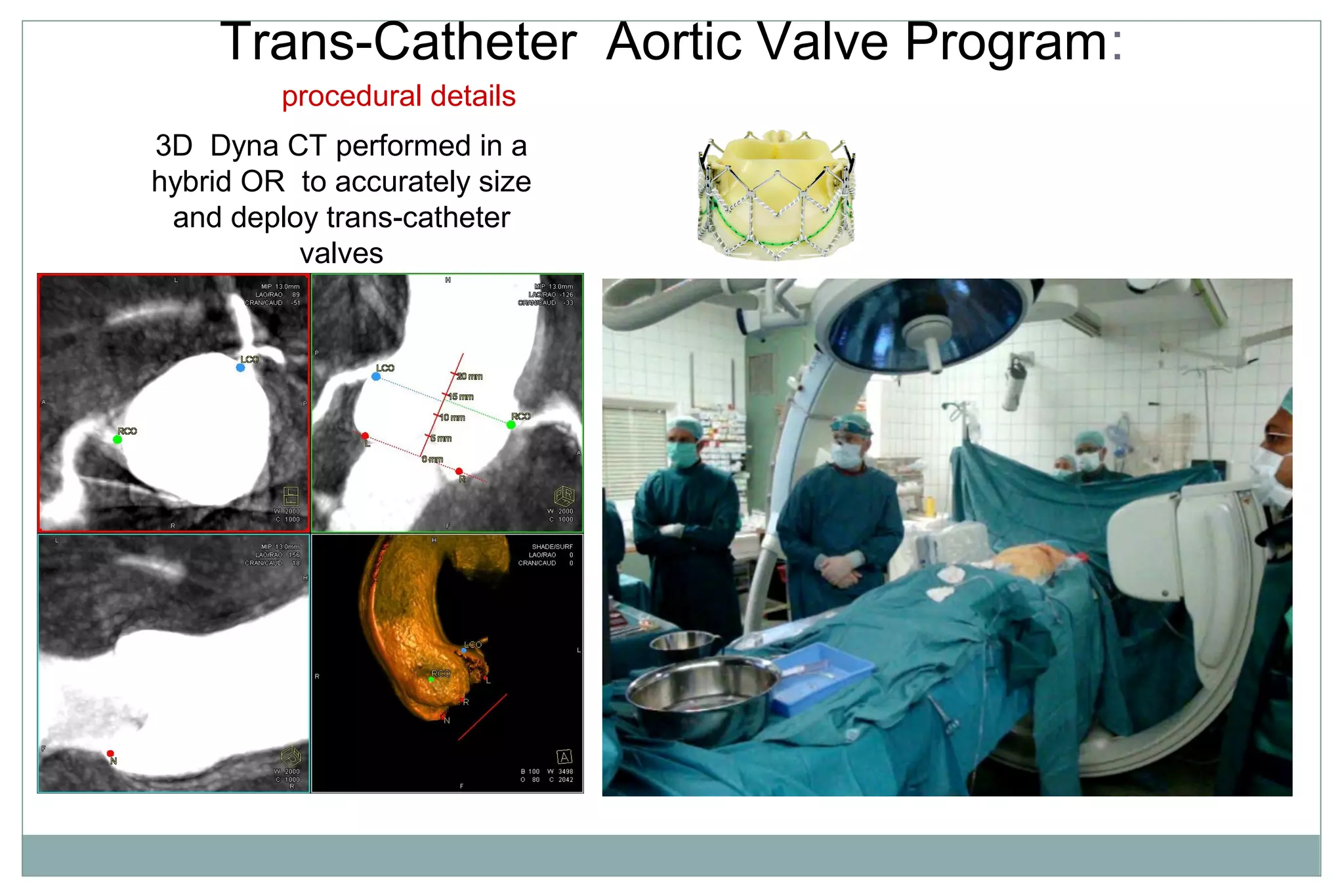 Trans-Catheter Aortic Valve Program:
3D Dyna CT performed in a
hybrid OR to accurately size
and deploy trans-catheter
valves
procedural details
 