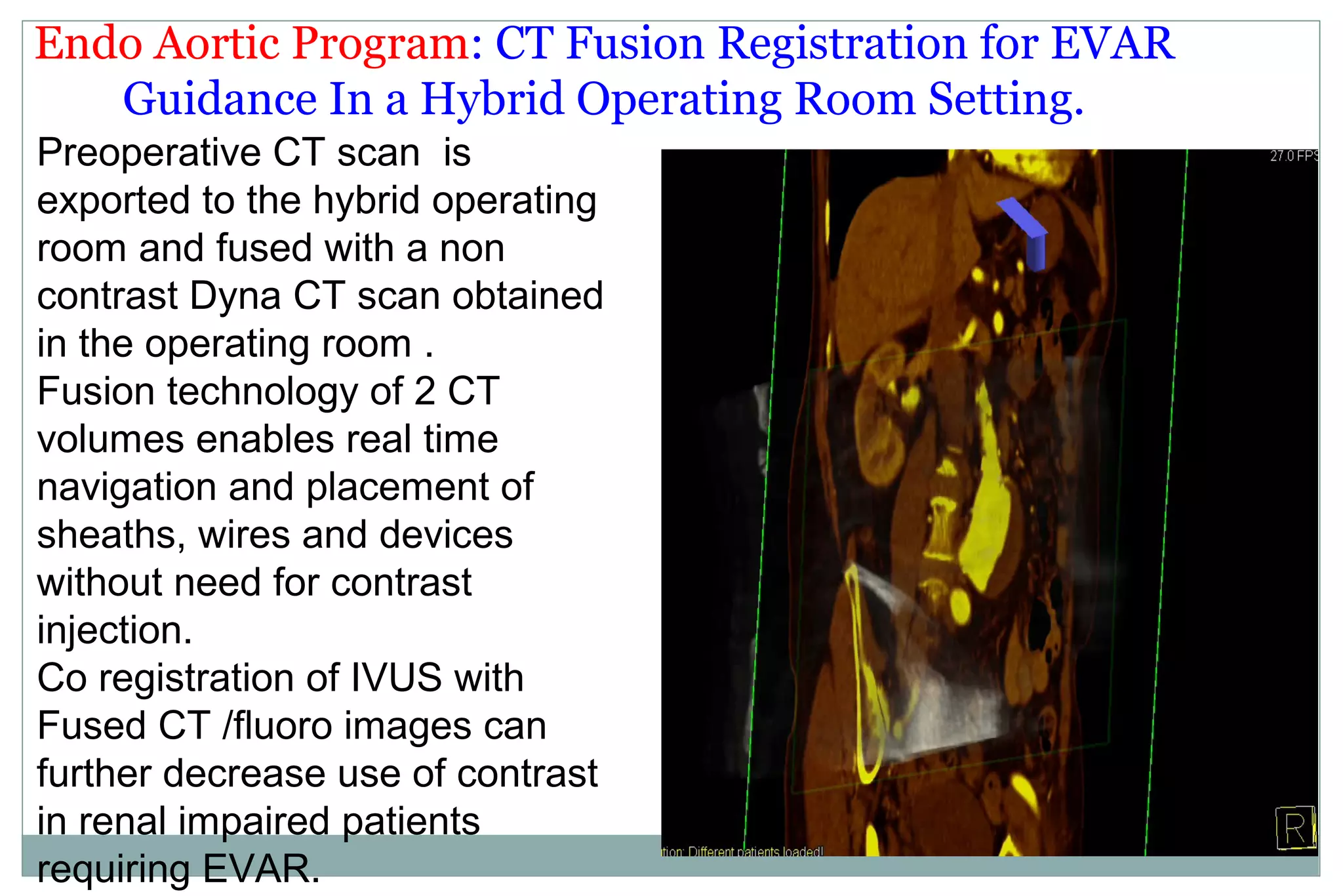 Endo Aortic Program: CT Fusion Registration for EVAR
Guidance In a Hybrid Operating Room Setting.
Preoperative CT scan is
exported to the hybrid operating
room and fused with a non
contrast Dyna CT scan obtained
in the operating room .
Fusion technology of 2 CT
volumes enables real time
navigation and placement of
sheaths, wires and devices
without need for contrast
injection.
Co registration of IVUS with
Fused CT /fluoro images can
further decrease use of contrast
in renal impaired patients
requiring EVAR.
 