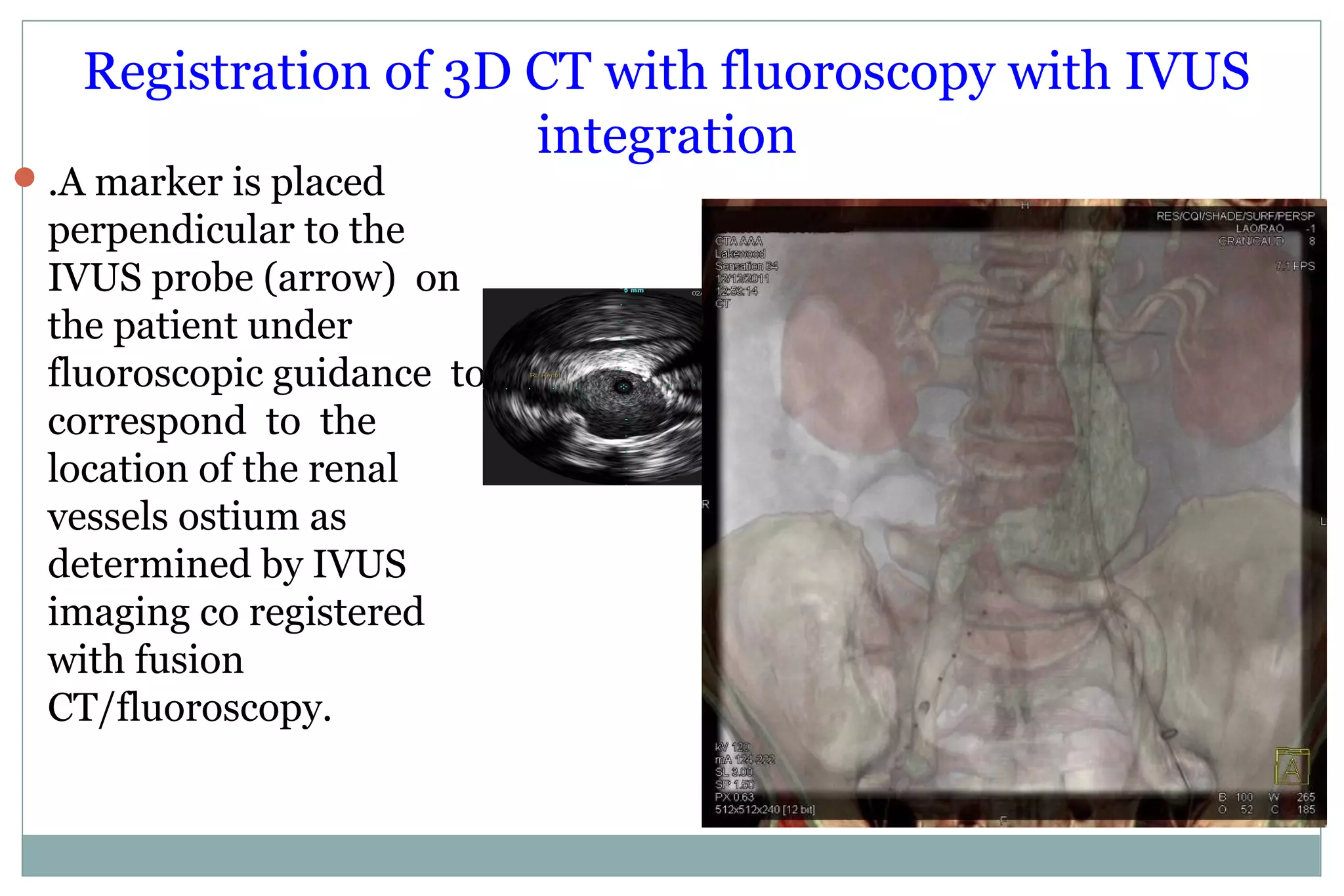 Registration of 3D CT with fluoroscopy with IVUS
integration
.A marker is placed
perpendicular to the
IVUS probe (arrow) on
the patient under
fluoroscopic guidance to
correspond to the
location of the renal
vessels ostium as
determined by IVUS
imaging co registered
with fusion
CT/fluoroscopy.
 