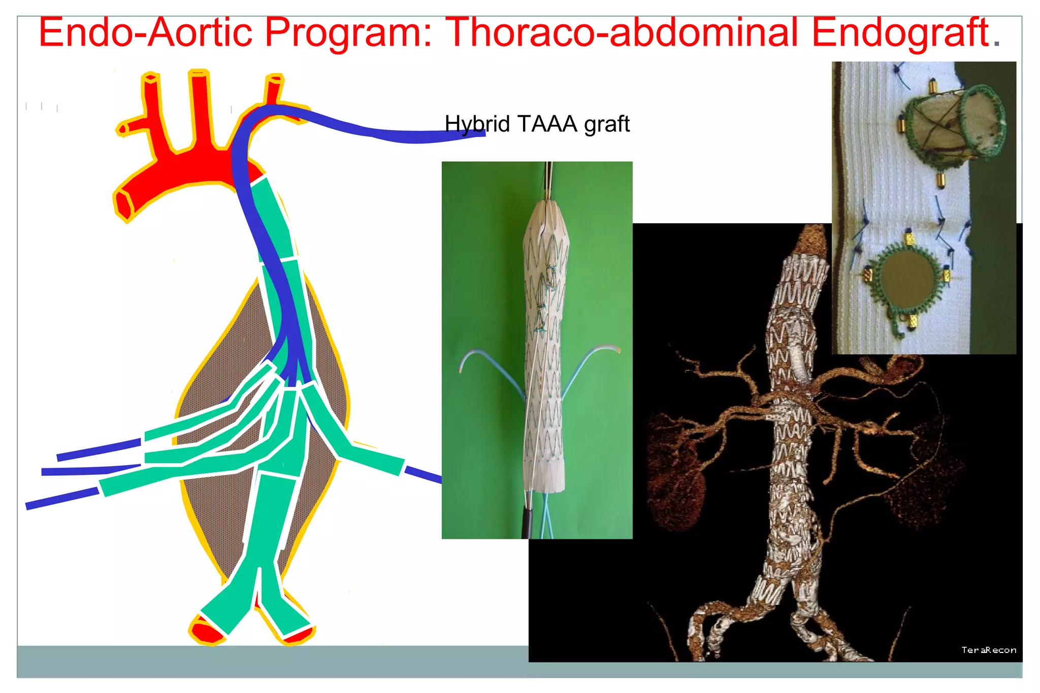 Endo-Aortic Program: Thoraco-abdominal Endograft.
Hybrid TAAA graft
 