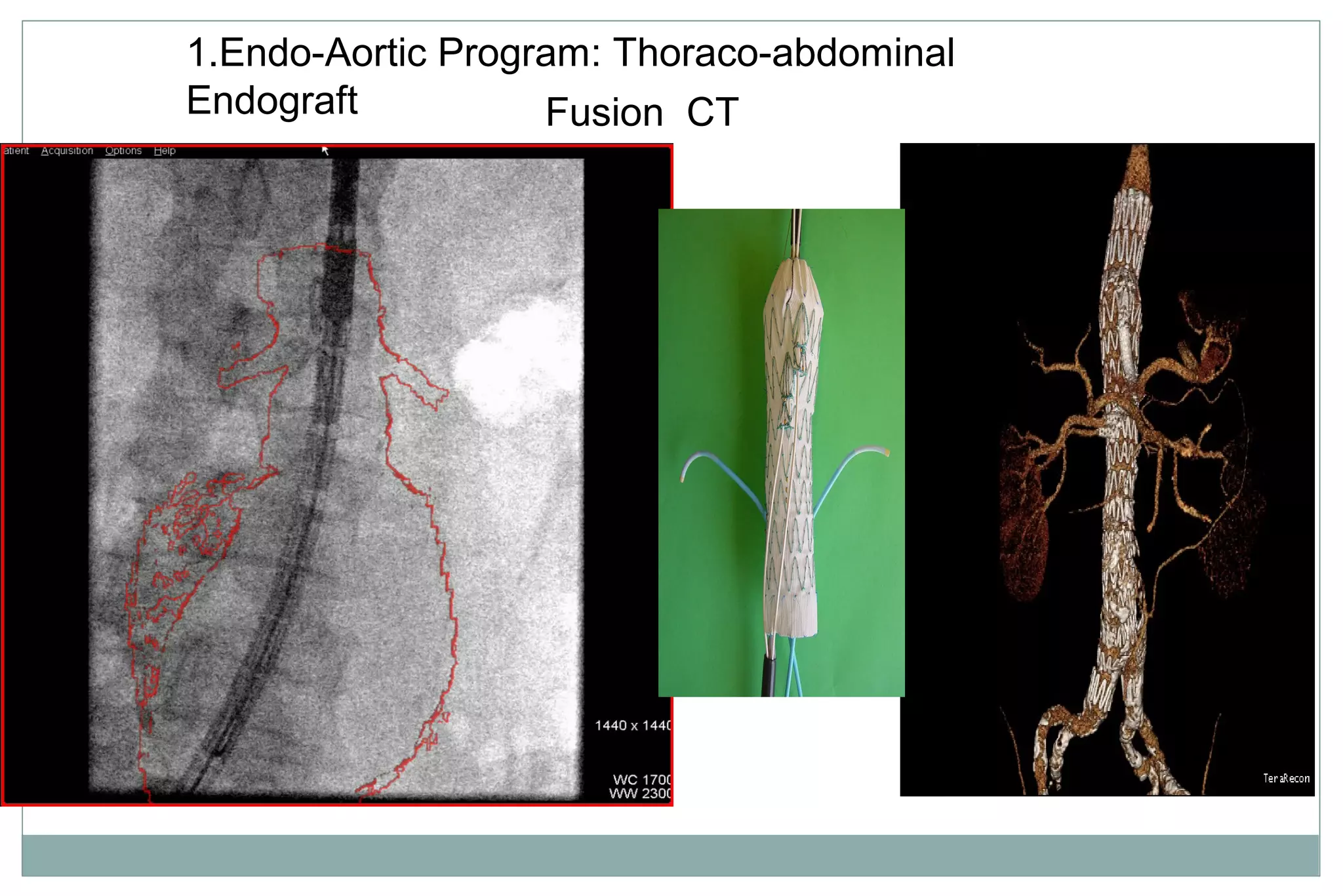Fusion CT
1.Endo-Aortic Program: Thoraco-abdominal
Endograft
 