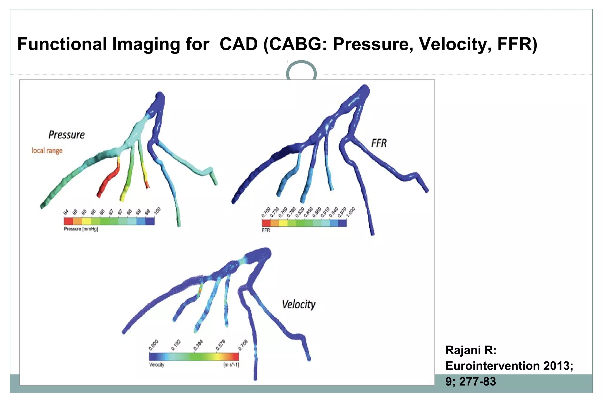 Functional Imaging for CAD (CABG: Pressure, Velocity, FFR)
Rajani R:
Eurointervention 2013;
9; 277-83
 
