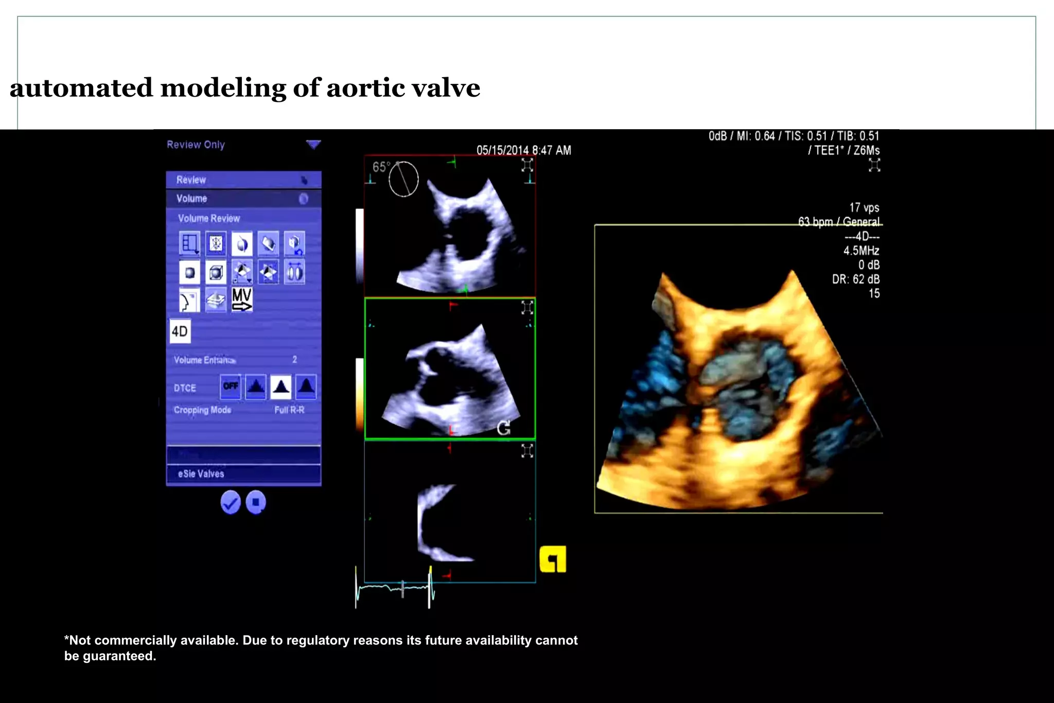 automated modeling of aortic valve
*Not commercially available. Due to regulatory reasons its future availability cannot
be guaranteed.
 
