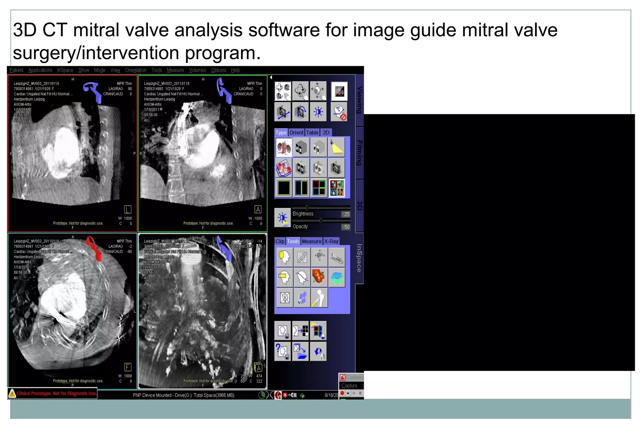 3D CT mitral valve analysis software for image guide mitral valve
surgery/intervention program.
 