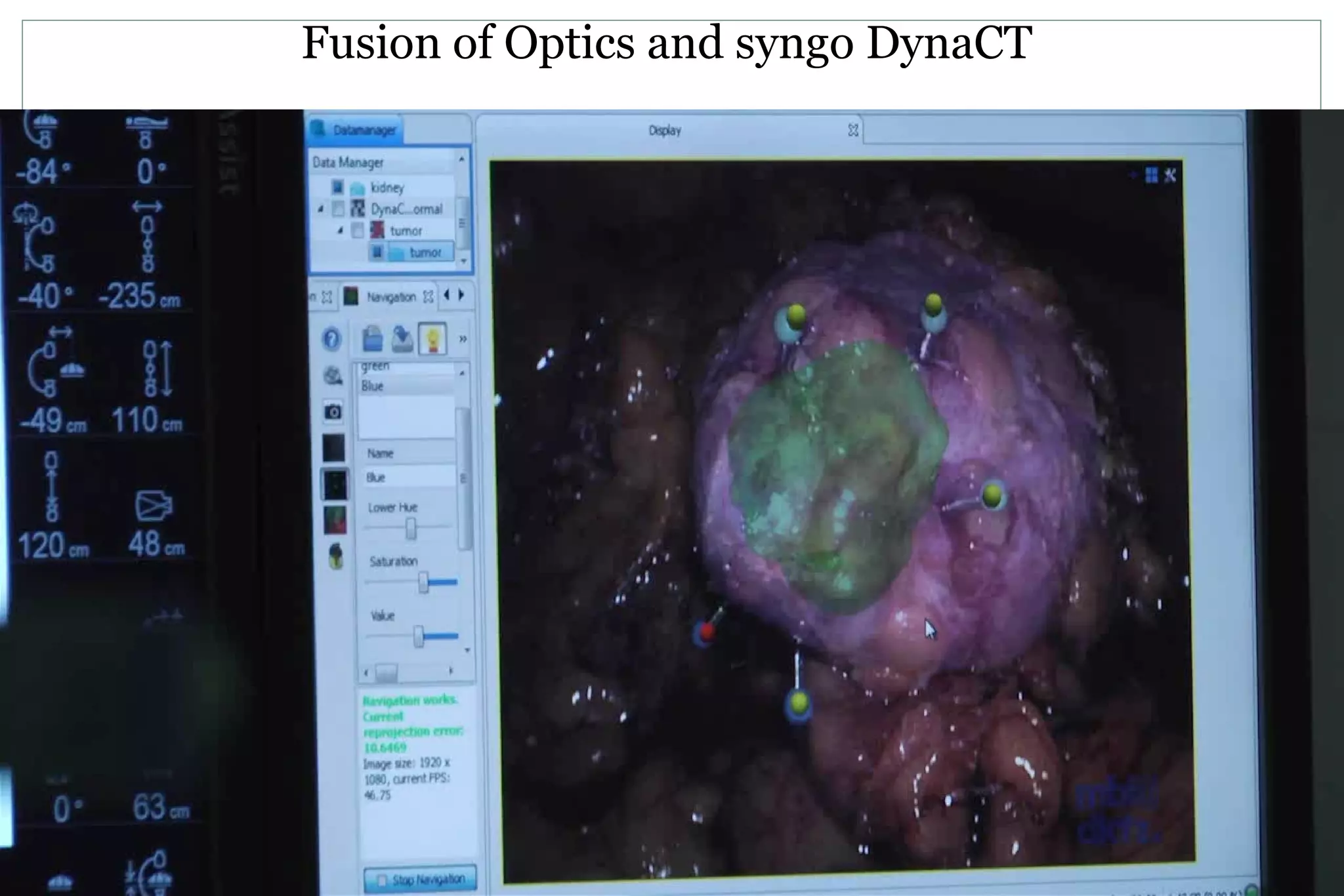 Fusion of Optics and syngo DynaCT
 