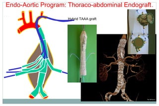 Endo-Aortic Program: Thoraco-abdominal Endograft.
Hybrid TAAA graft
 