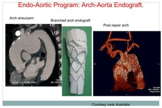 Endo-Aortic Program: Arch-Aorta Endograft.
Arch aneurysm
Branched arch endograft
Post repair arch
Courtesy cook Australia
 